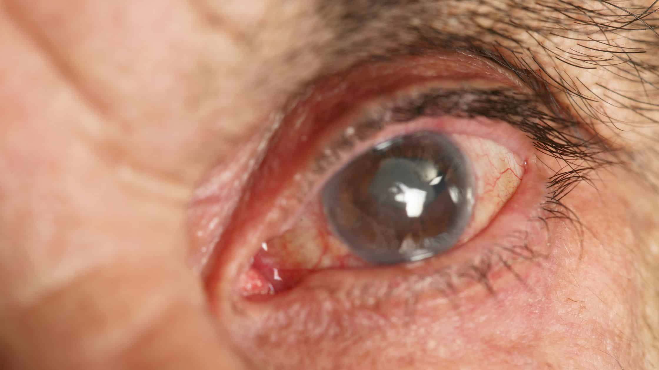 what's the difference between cataract surgery and lasik surgery